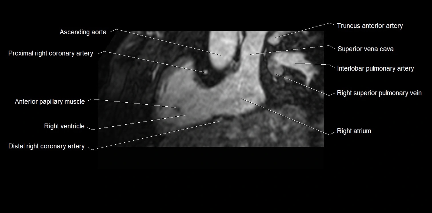 MRI heart and coronary arteries two chamber(sagittal)  anatomy image 12.webp